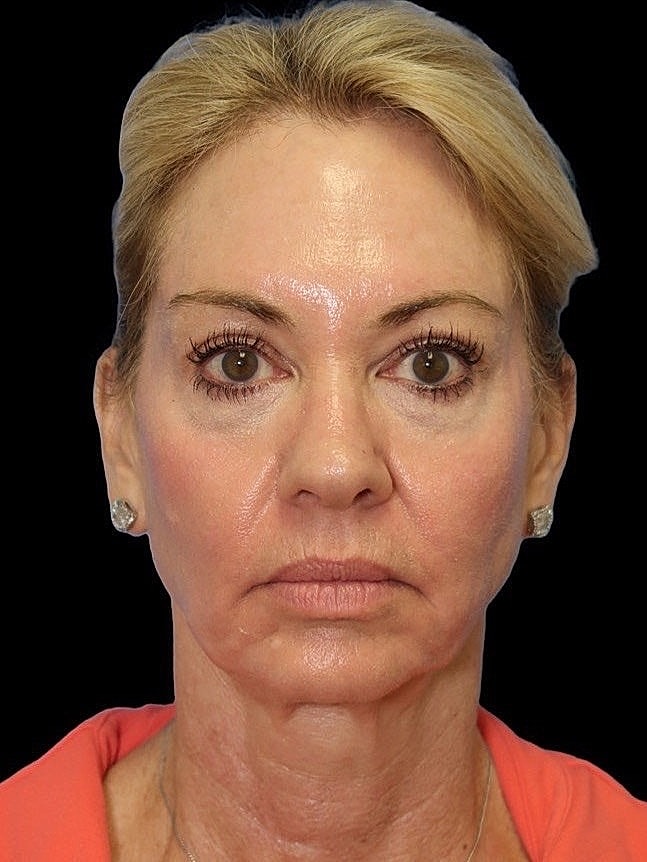 Deep Plane Facelift Gallery Before & After