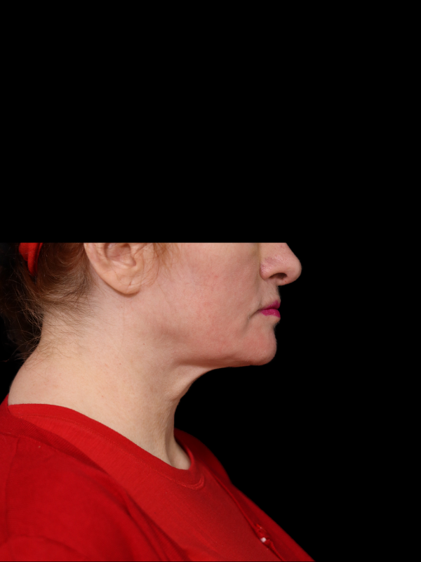 Deep Plane Facelift Gallery Before & After