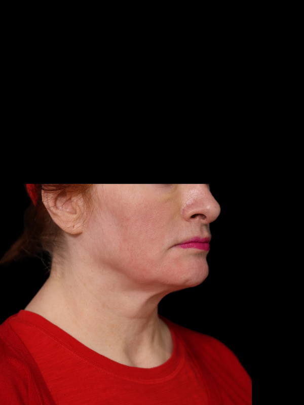 Deep Plane Facelift Gallery Before & After