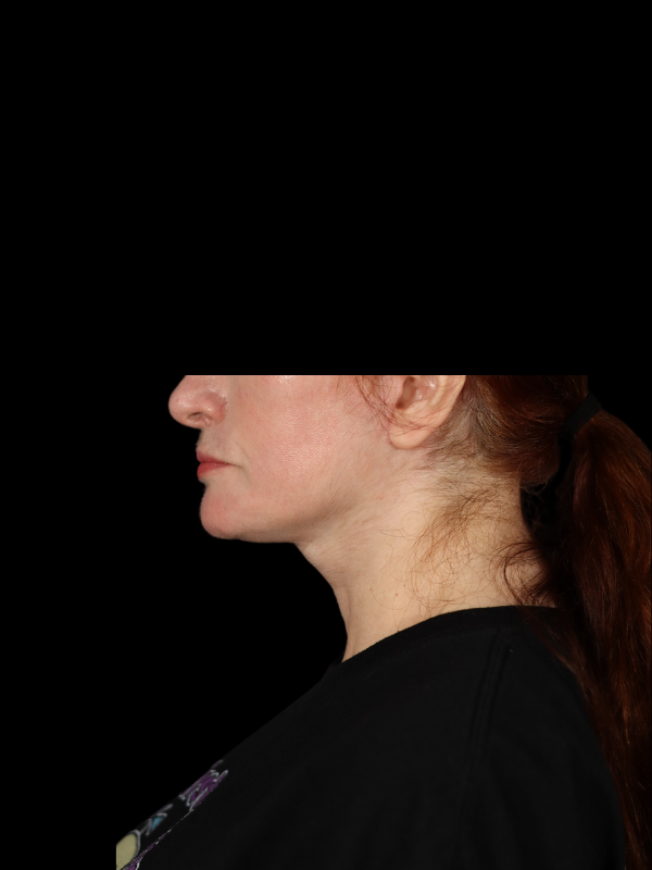 Deep Plane Facelift Gallery Before & After