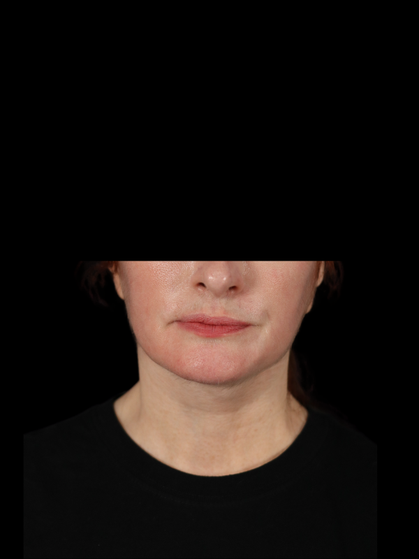 Deep Plane Facelift Gallery Before & After