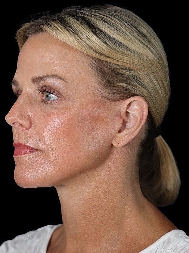 Deep Plane Facelift Gallery Before & After