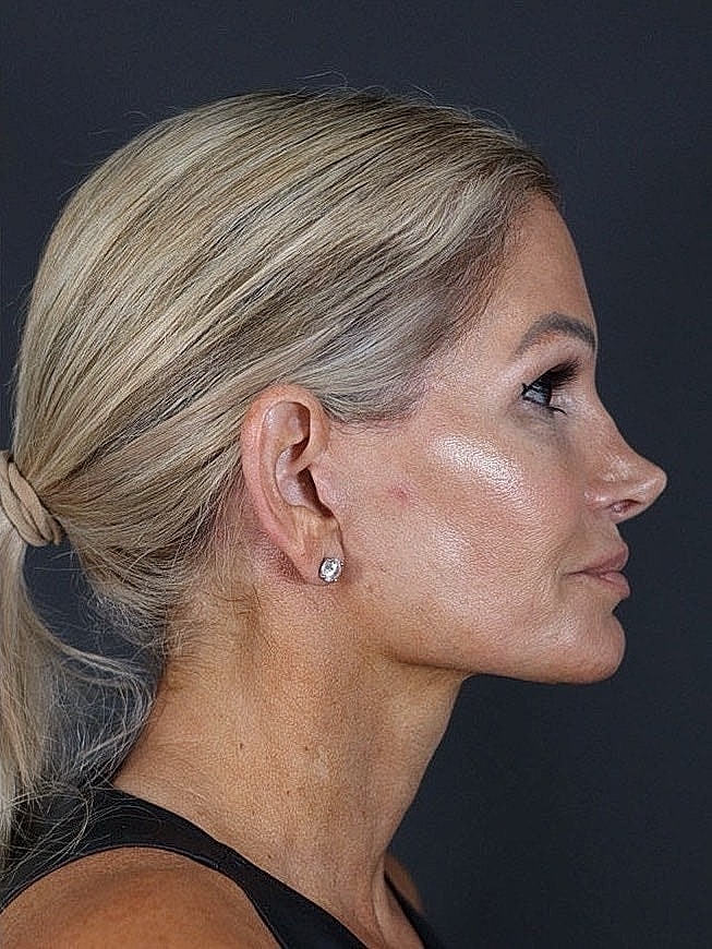 Deep Plane Facelift Gallery Before & After