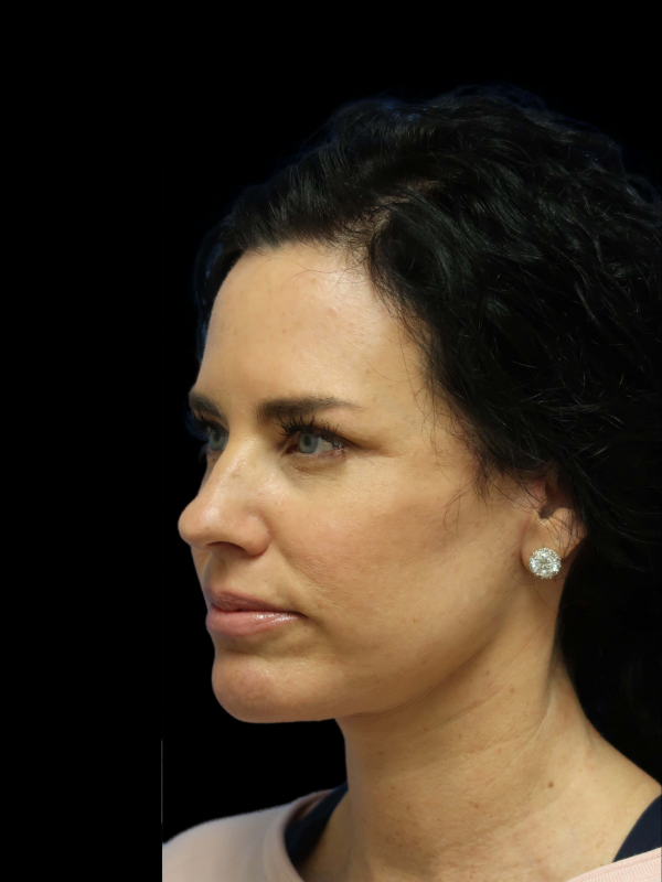 Deep Plane Facelift Gallery Before & After