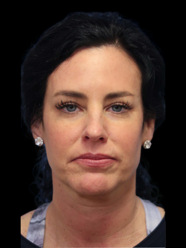 Deep Plane Facelift Gallery Before & After