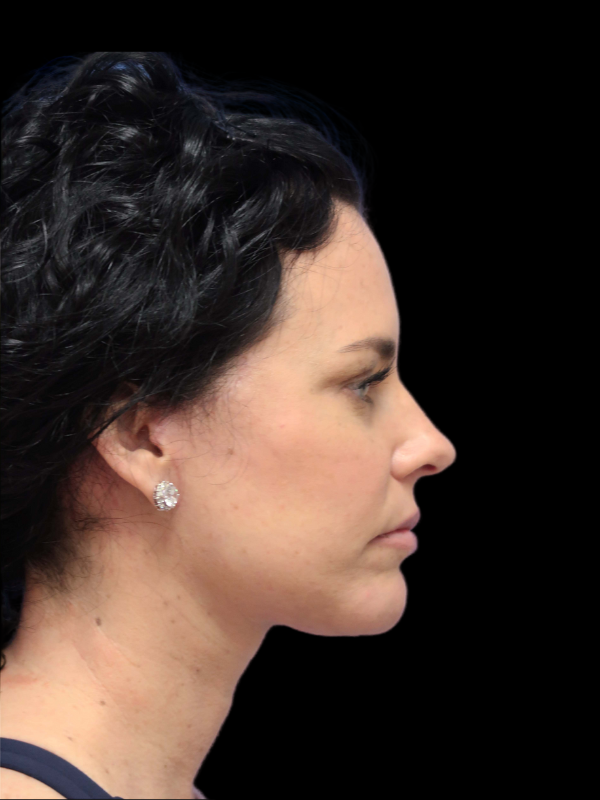 Deep Plane Facelift Gallery Before & After