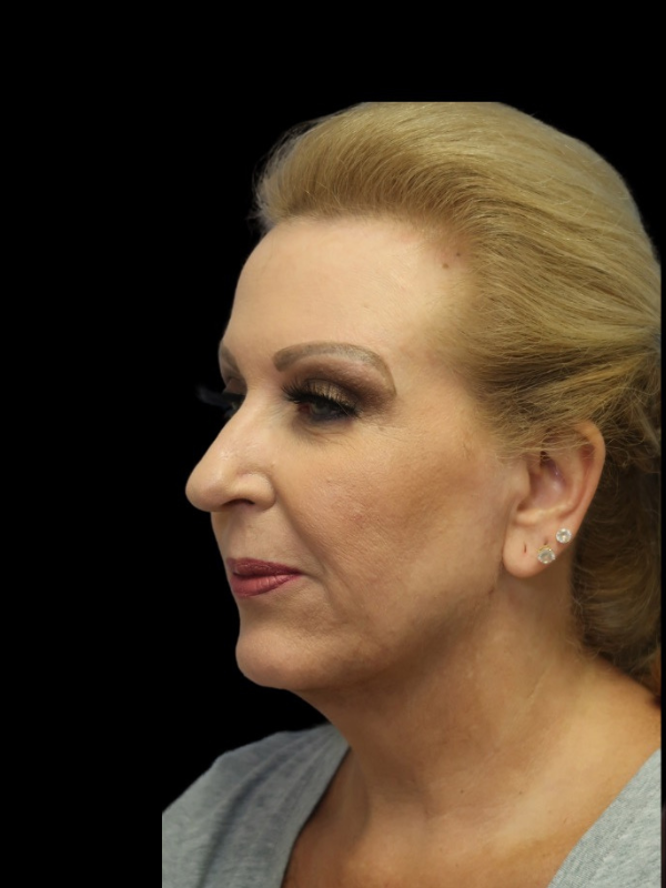 Deep Plane Facelift Gallery Before & After