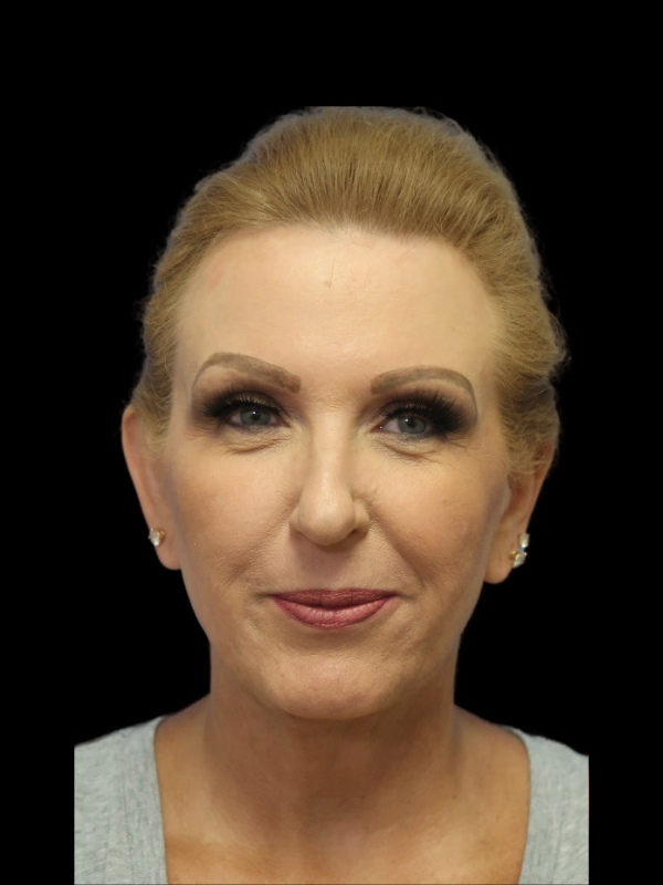 Deep Plane Facelift Gallery Before & After