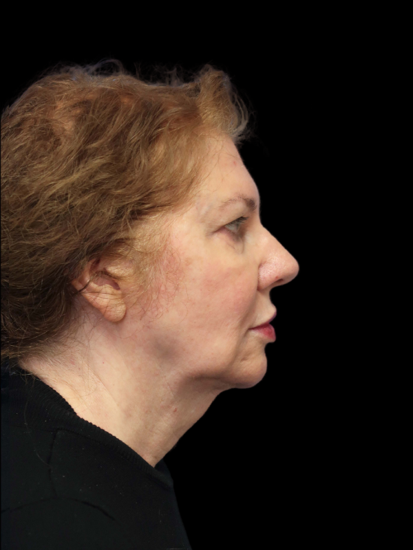 Deep Plane Facelift Gallery Before & After