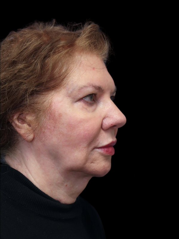 Deep Plane Facelift Gallery Before & After