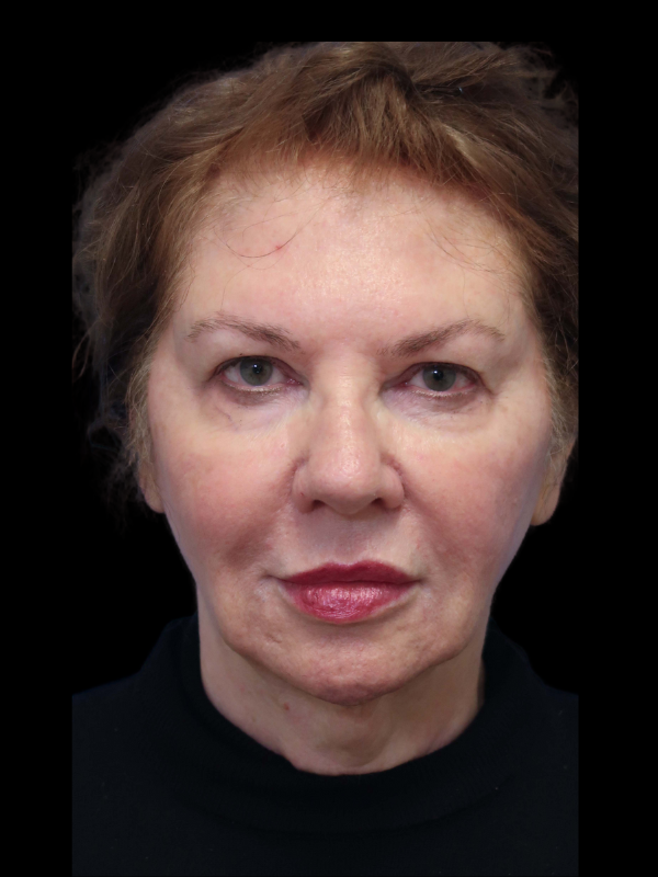 Deep Plane Facelift Gallery Before & After