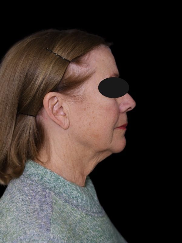 Deep Plane Facelift Gallery Before & After