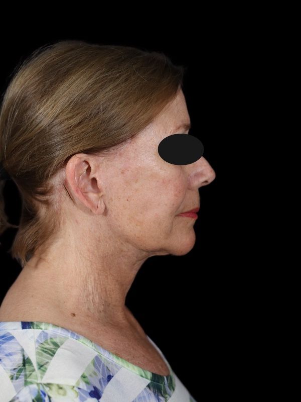 Deep Plane Facelift Gallery Before & After