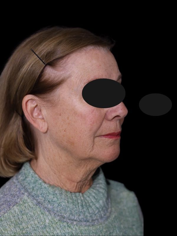 Deep Plane Facelift Gallery Before & After