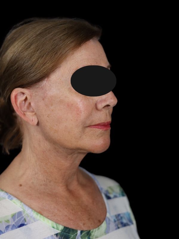 Deep Plane Facelift Gallery Before & After