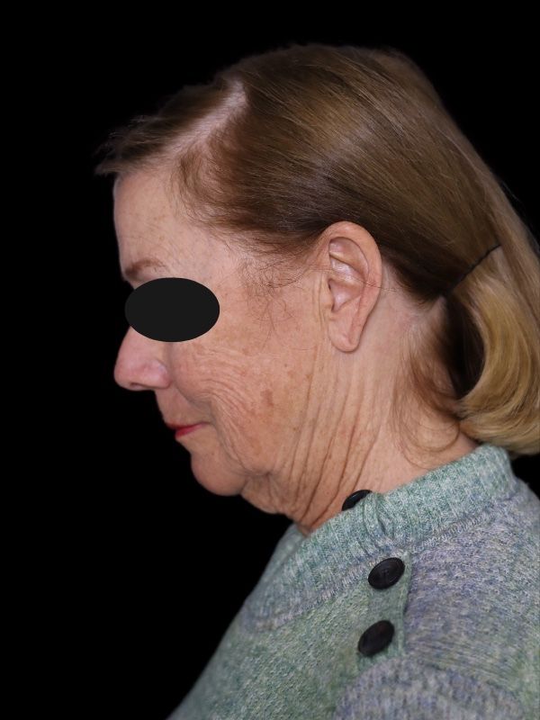 Deep Plane Facelift Gallery Before & After