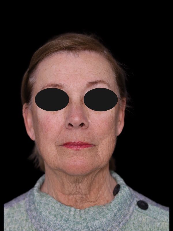 Deep Plane Facelift Gallery Before & After