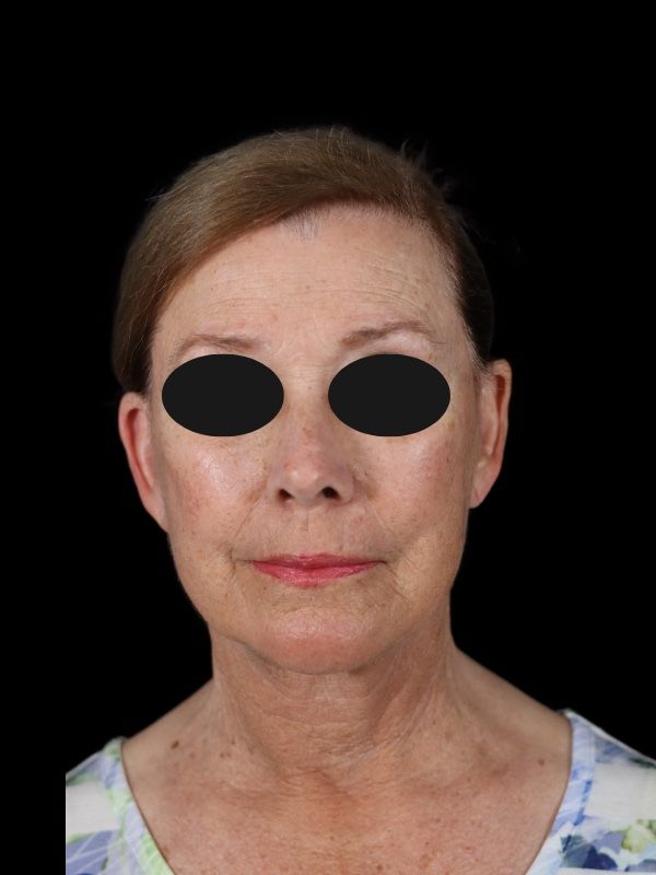 Deep Plane Facelift Gallery Before & After