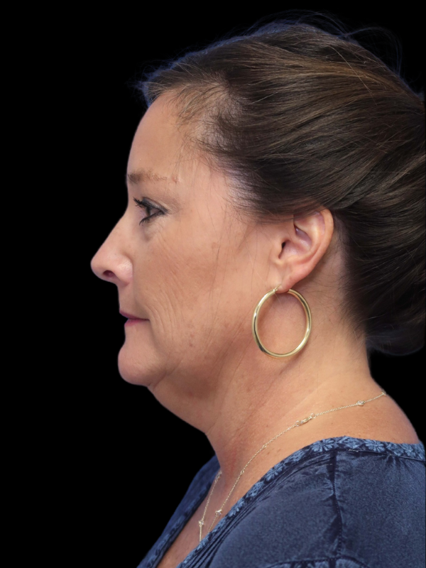 Deep Plane Facelift Gallery Before & After