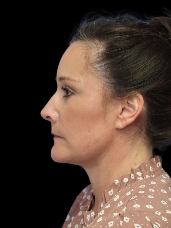 Deep Plane Facelift Gallery Before & After