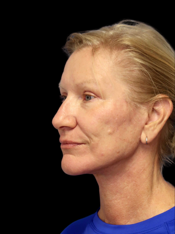 Deep Plane Facelift Gallery Before & After