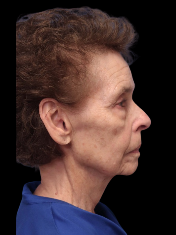Deep Plane Facelift Gallery Before & After
