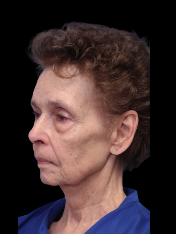 Deep Plane Facelift Gallery Before & After