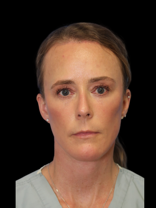 Deep Plane Facelift Gallery Before & After