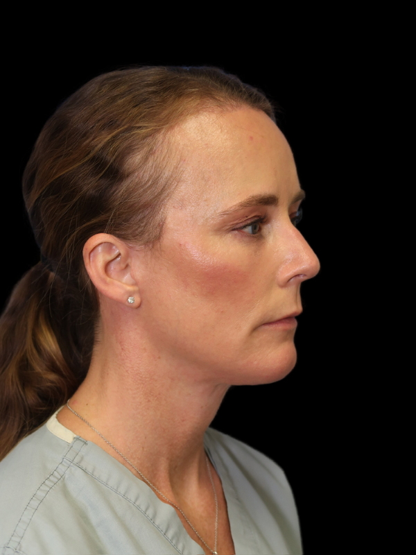 Deep Plane Facelift Gallery Before & After