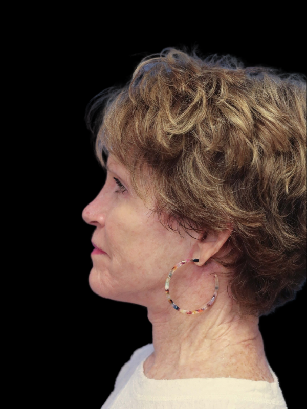 Deep Plane Facelift Gallery Before & After