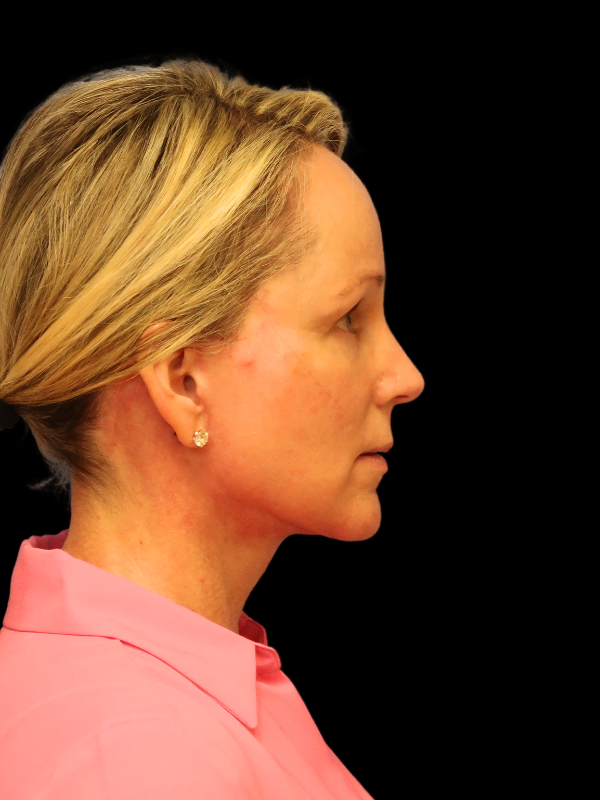 Deep Plane Facelift Gallery Before & After