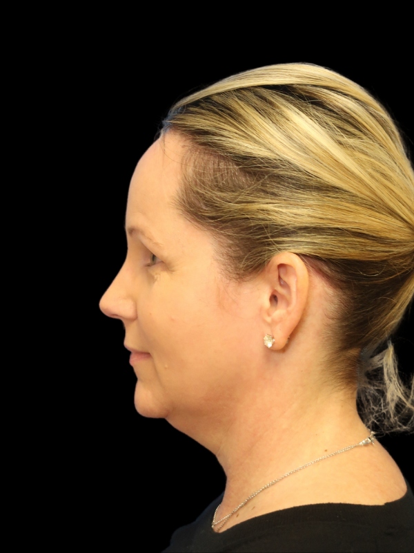 Deep Plane Facelift Gallery Before & After