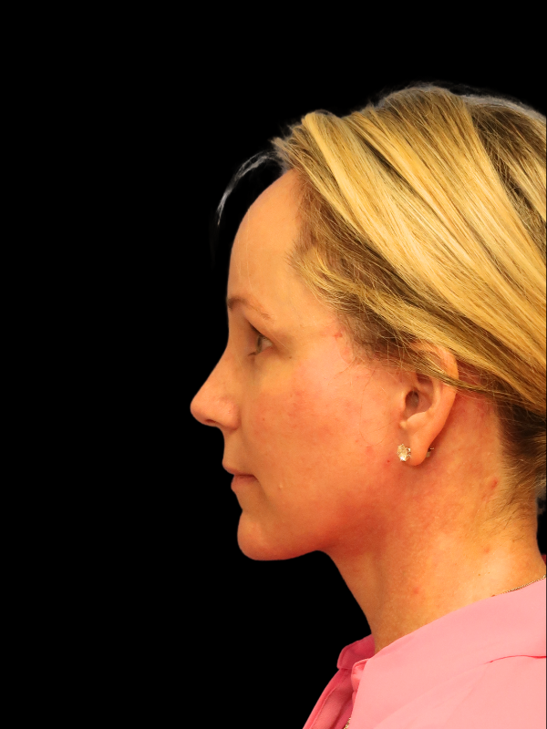 Deep Plane Facelift Gallery Before & After