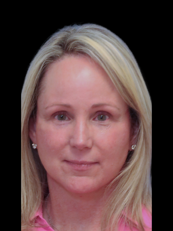 Deep Plane Facelift Gallery Before & After