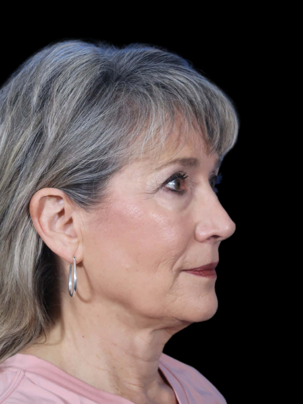 Deep Plane Facelift Gallery Before & After