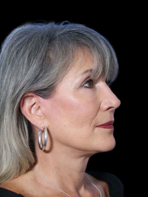 Deep Plane Facelift Gallery Before & After