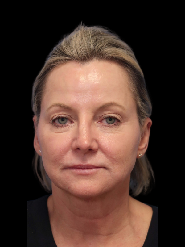 Deep Plane Facelift Gallery Before & After