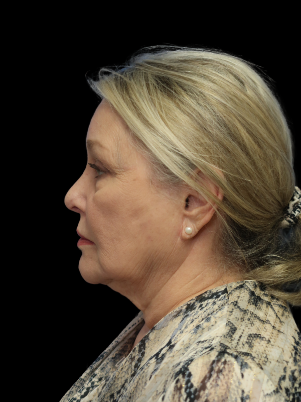 Deep Plane Facelift Gallery Before & After