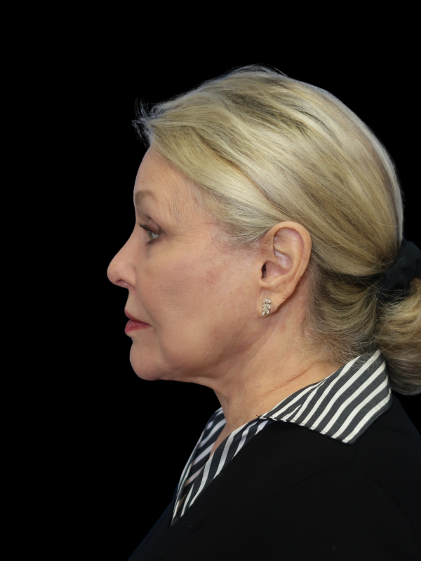 Deep Plane Facelift Gallery Before & After