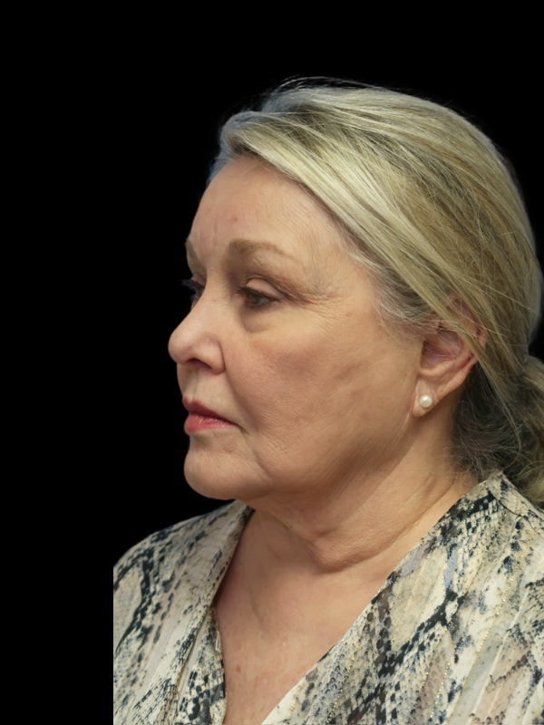 Deep Plane Facelift Gallery Before & After