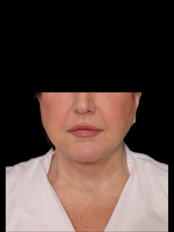 Deep Plane Facelift Gallery Before & After