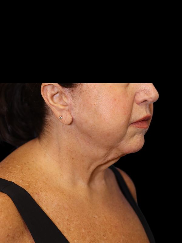 Deep Plane Facelift Gallery Before & After