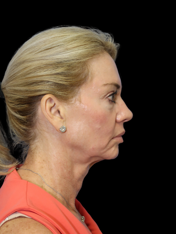 Deep Plane Facelift Gallery Before & After