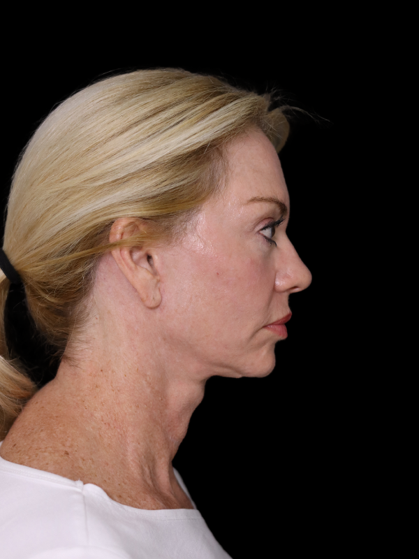 Deep Plane Facelift Gallery Before & After