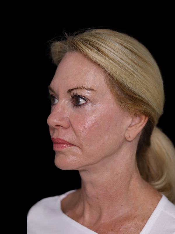 Deep Plane Facelift Gallery Before & After