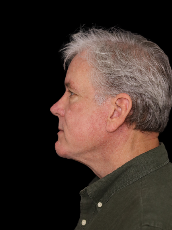 Deep Plane Facelift Gallery Before & After