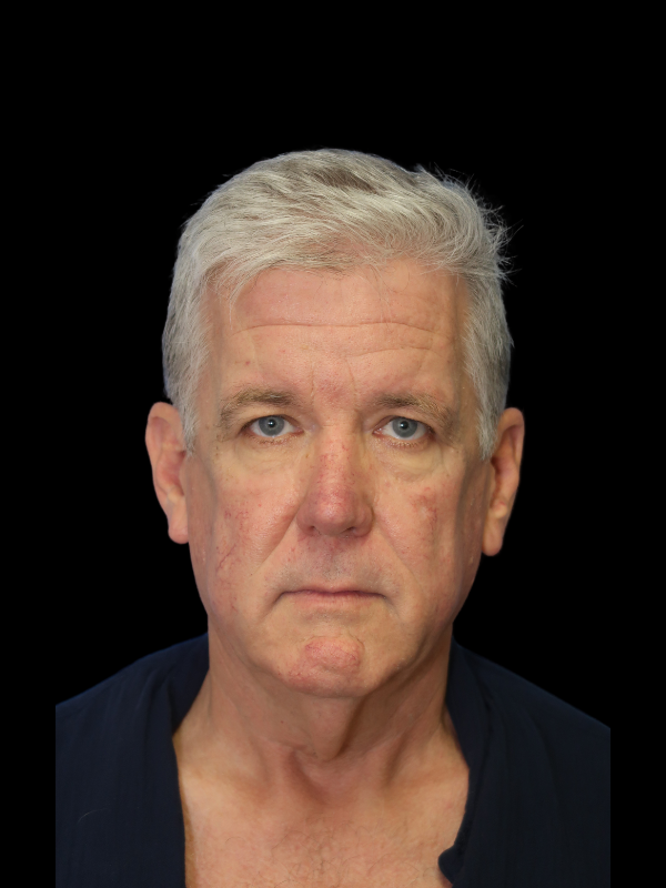 Deep Plane Facelift Gallery Before & After