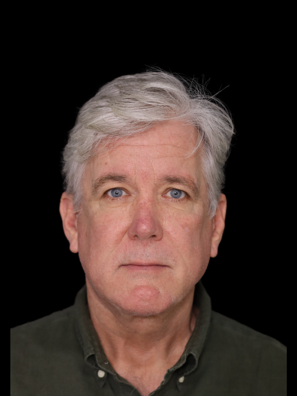 Deep Plane Facelift Gallery Before & After