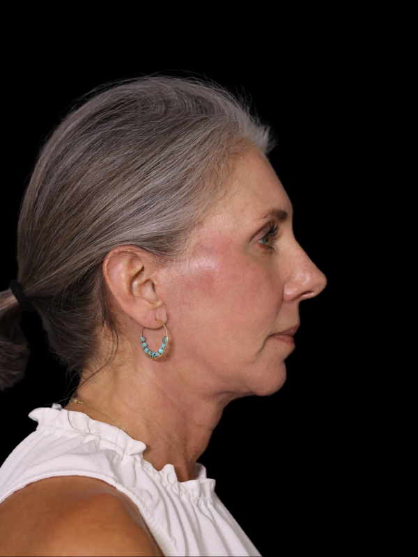 Deep Plane Facelift Gallery Before & After