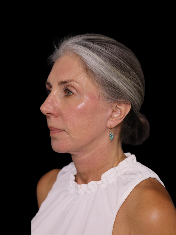 Deep Plane Facelift Gallery Before & After